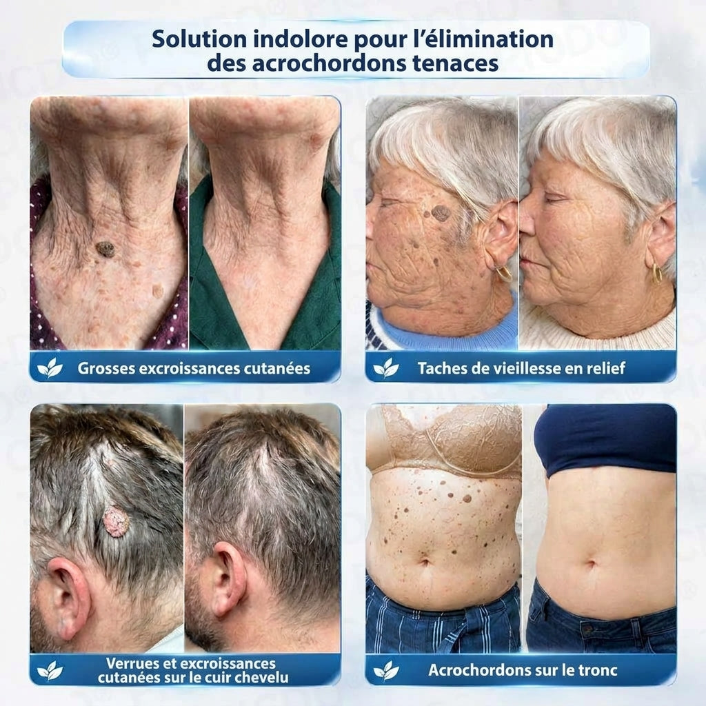 HISKIN® Crème Rénovatrice Ciblée 10-en-1 (Acrochordons & Taches) – Formule Botanique Sans Douleur ni Cicatrice, 7 Jours