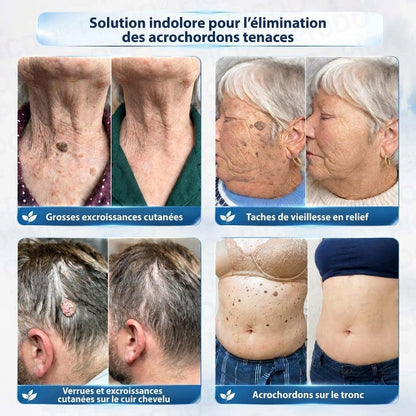 HISKIN® Crème Rénovatrice Ciblée 10-en-1 (Acrochordons & Taches) – Formule Botanique Sans Douleur ni Cicatrice, 7 Jours