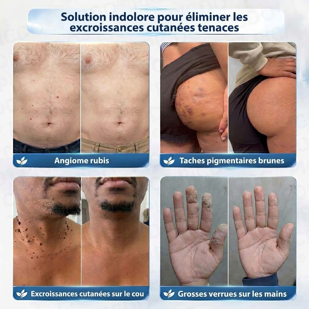 HISKIN® Crème Rénovatrice Ciblée 10-en-1 (Acrochordons & Taches) – Formule Botanique Sans Douleur ni Cicatrice, 7 Jours