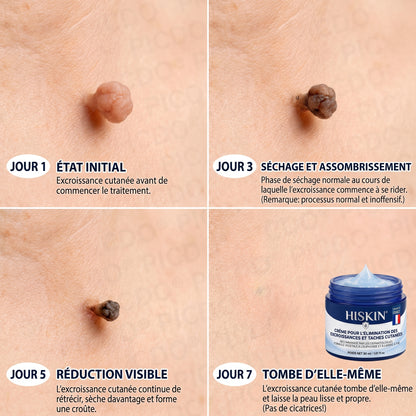 HISKIN® Crème Rénovatrice Ciblée 10-en-1 (Acrochordons & Taches) – Formule Botanique Sans Douleur ni Cicatrice, 7 Jours